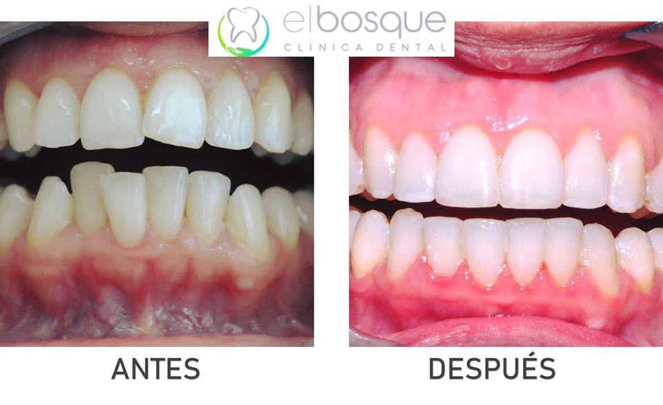 caso de ortodoncia en la Clínica Dental El Bosque de Villaviciosa de Odón Madrid
