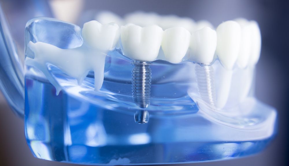 Como elegir los implantes dentales y que beneficios puede tener dicha elección
