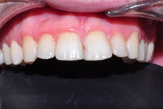 recontorneado dental