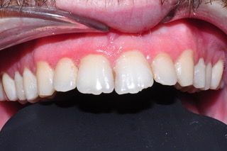 foto de paciente con problema que solucionamos con recontorneado dental en Madrid
