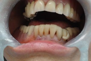 reconstruir esteticamente con composite dientes anterio-inferiores y prótesis esquelética