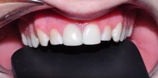 restauración dental de incisivo superior derecho con color similar