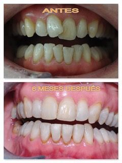 apiñamiento dental solución con ortodoncia antes y después