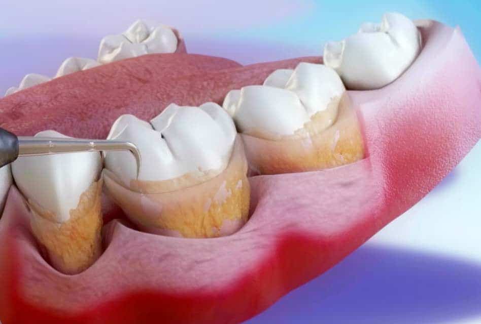 periodoncia contra gingivitis y periodontitis