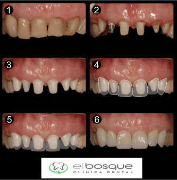 tratamientos de estética dental en Villaviciosa de Odón y Boadilla del Monte