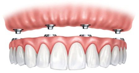 tratamientos de implantes dentales all on four en Villaviciosa de Odón y Boadilla del Monte
