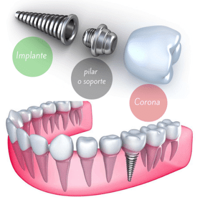 implantes dentales de titanio en Villaviciosa de Odón y Boadilla del Monte