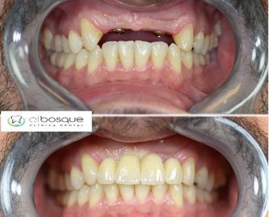 prótesis sobre implantes dentales en Villaviciosa de Odón y Boadilla del Monte