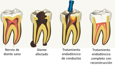 endodoncia en Villaviciosa de Odón y Boadilla del Monte