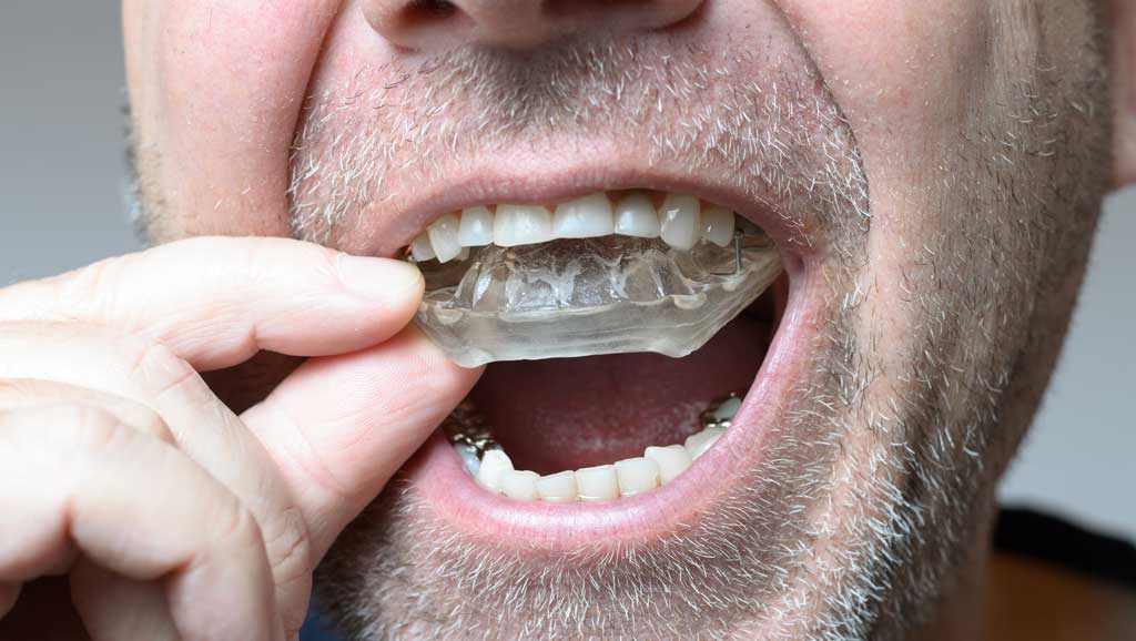 desencadentantes del bruxismo dental