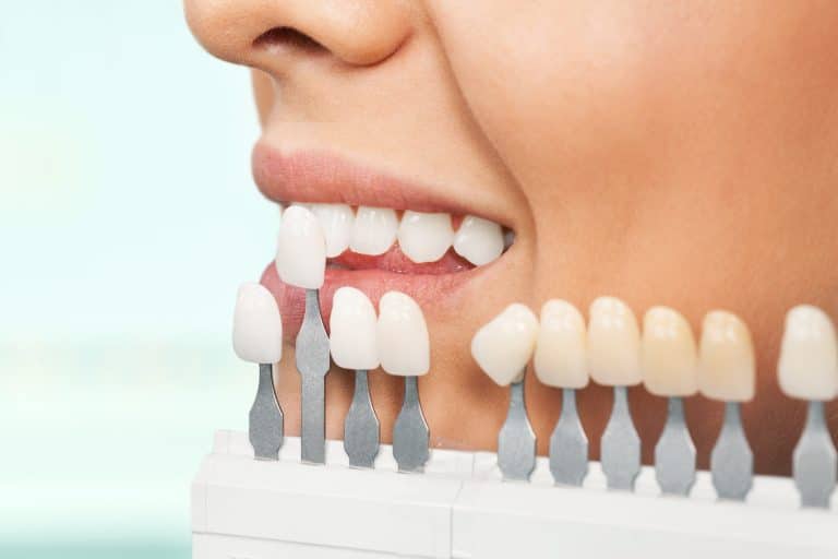 carillas-dentales-cual-es-la-mejor-opcion